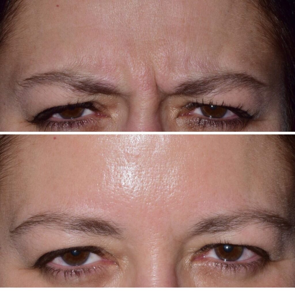 Botox in Franklin, MI