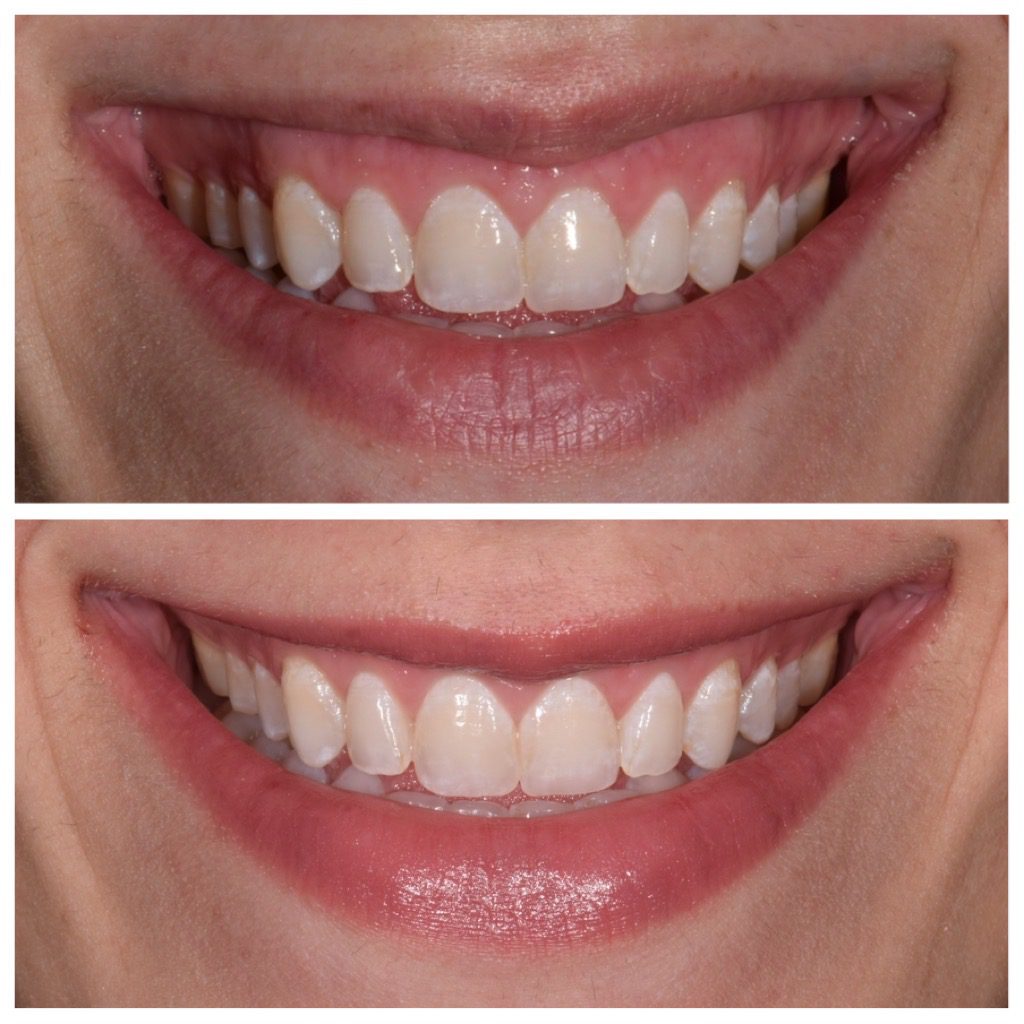Botox treatment in Franklin, MI
