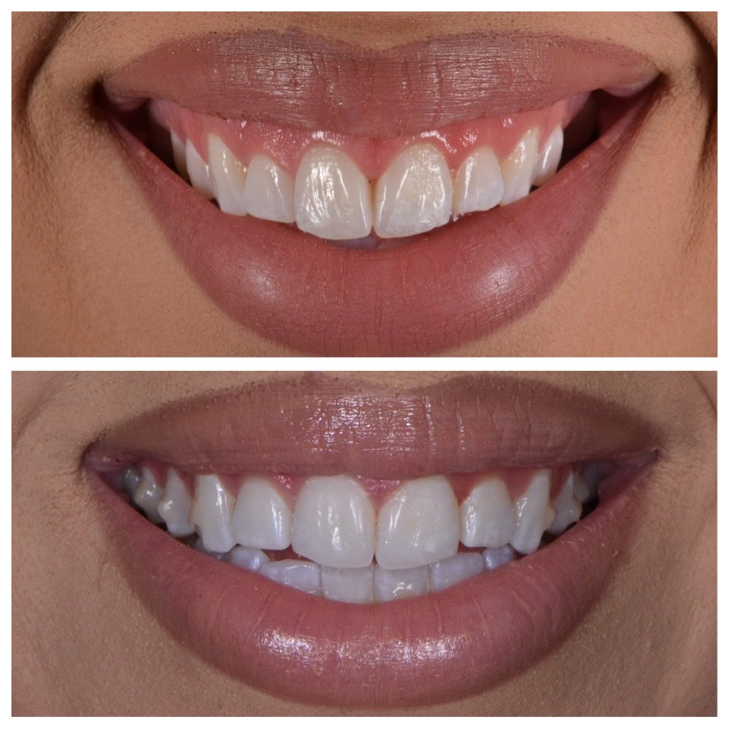 Botox at the dentist in Franklin, MI
