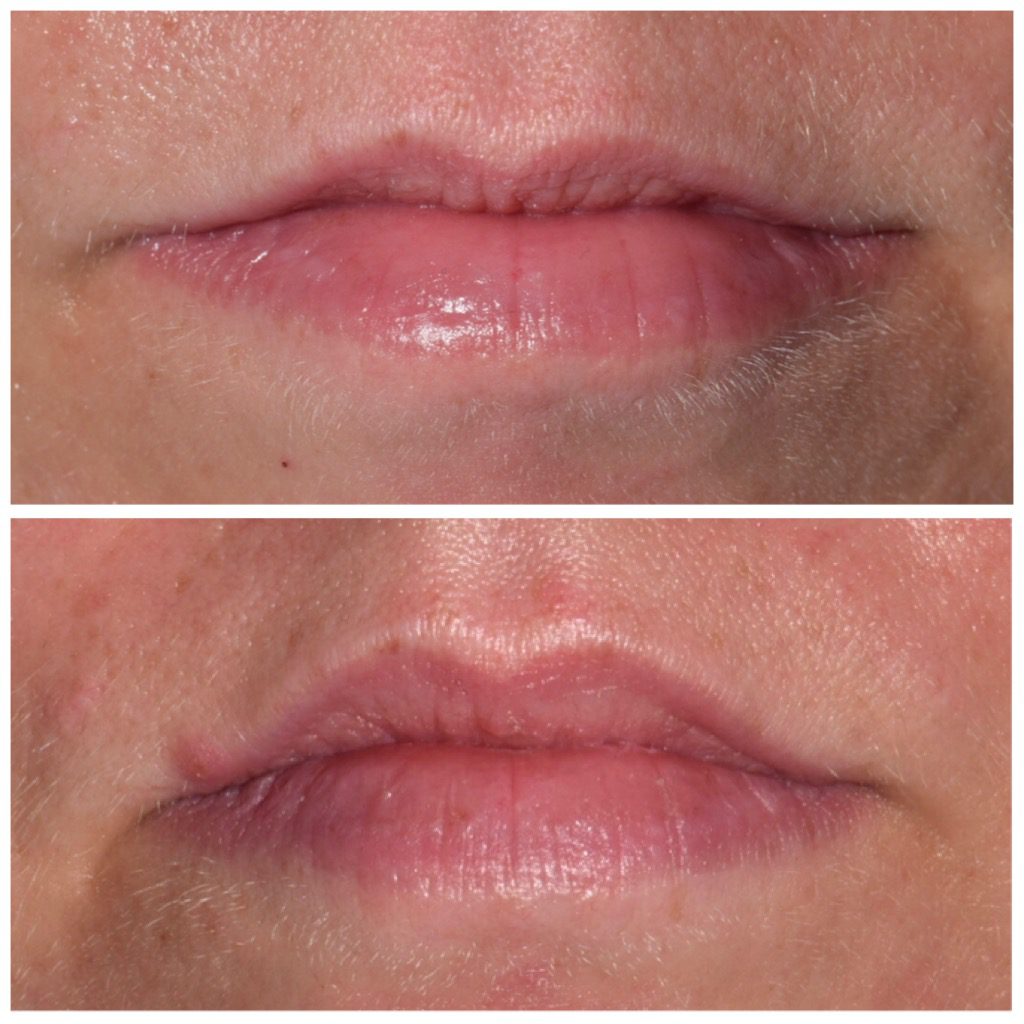 Botox in Franklin, MI office
