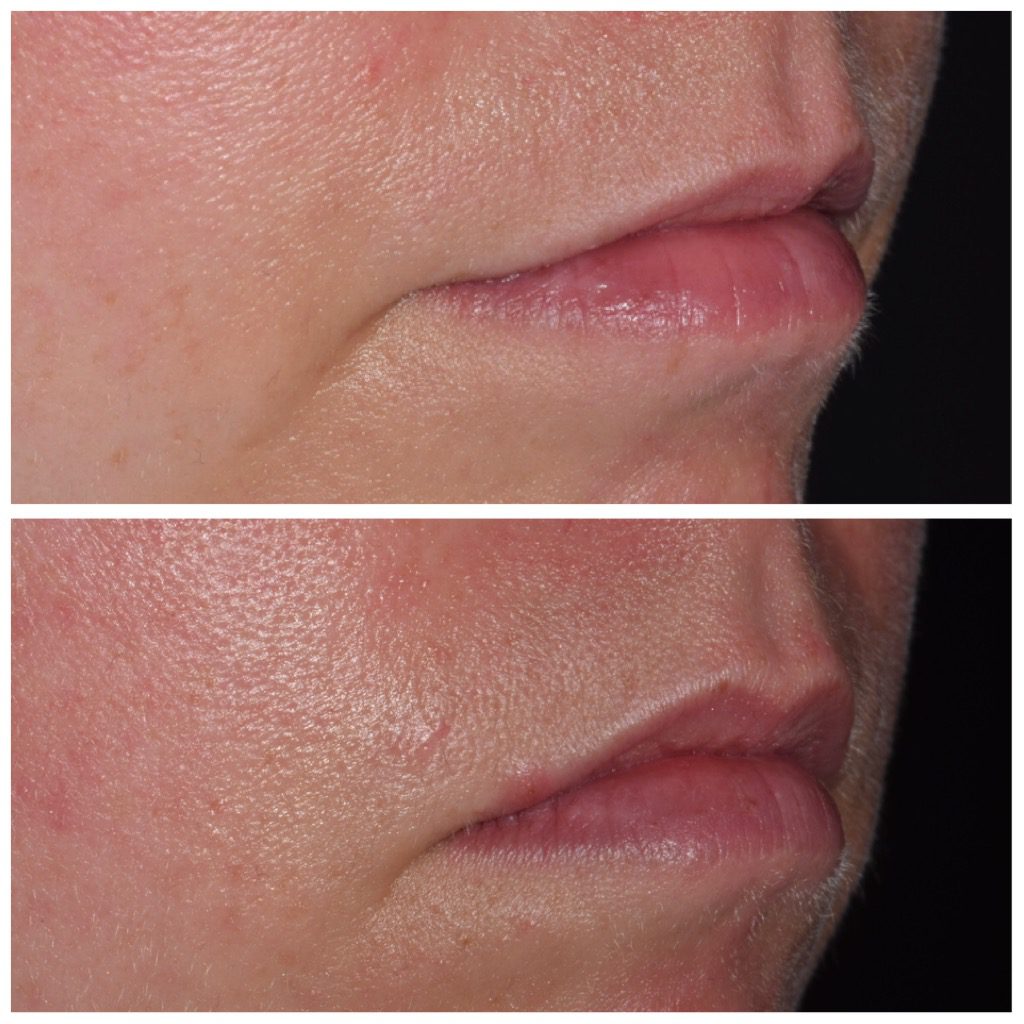 Botox Cosmetic in our Franklin, MI office