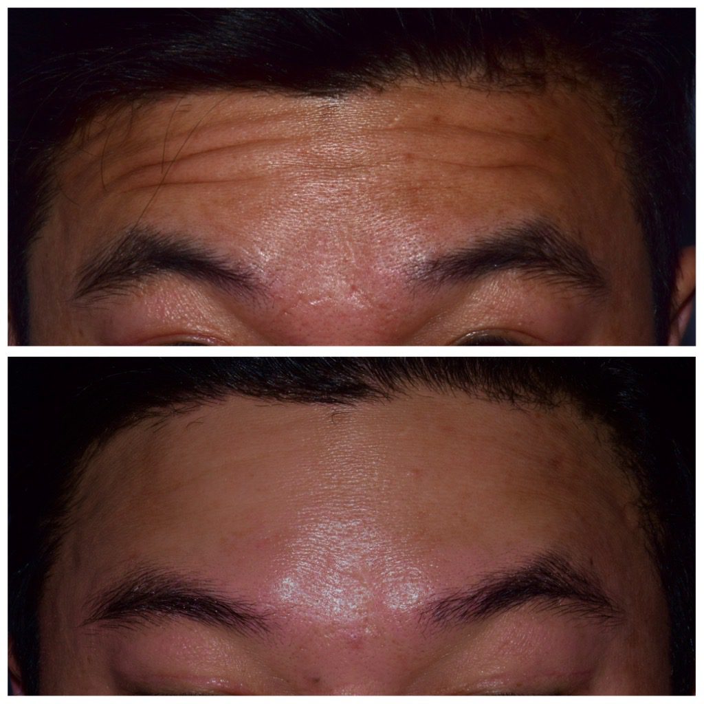 Botox treatment in Franklin MI