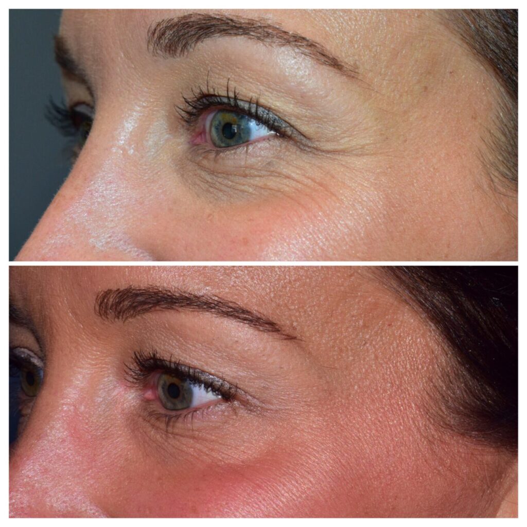 Botox Cosmetic in Franklin, MI dental office