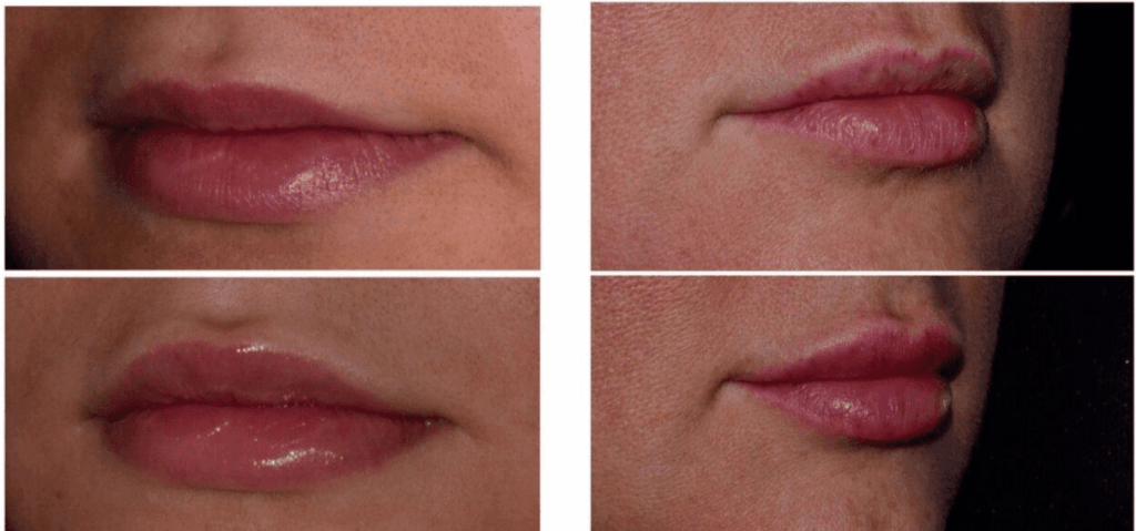 Botox Cosmetic in our Franklin, MI office