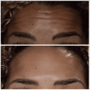 Botox in Franklin, MI