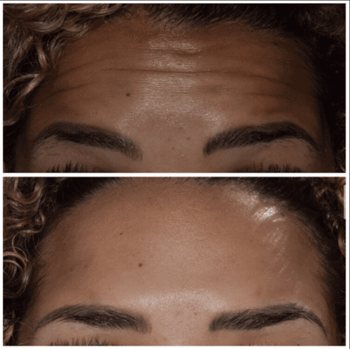 Botox in Franklin, MI