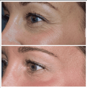 Botox in our Franklin, MI dental office