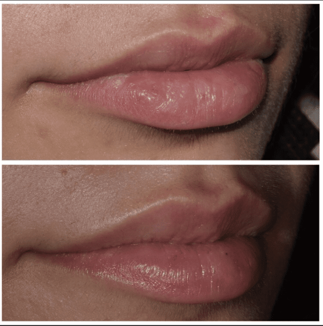 Botox in Franklin, MI