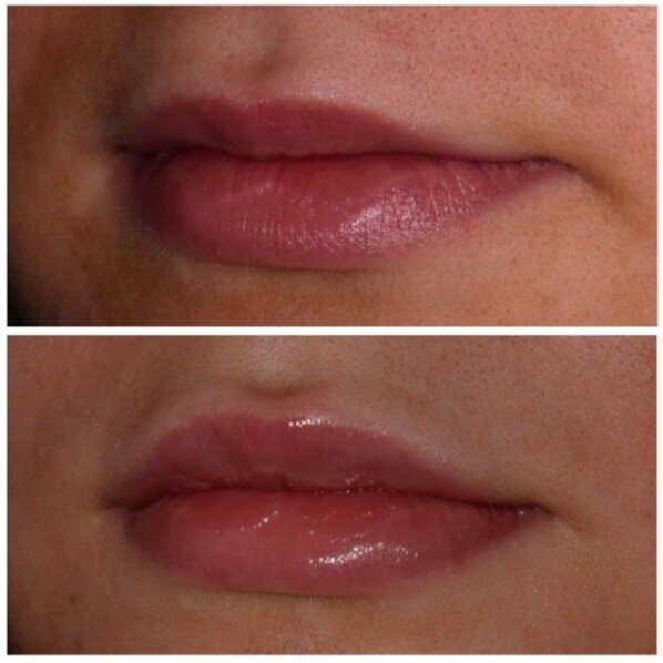 Botox Cosmetic in Franklin, MI