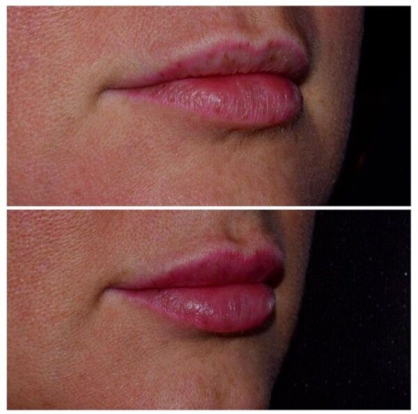 Botox in Franklin MI