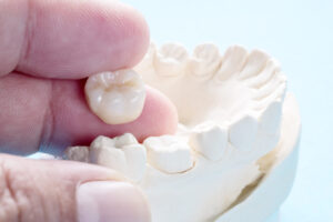 Dental Crown FAQs Answered