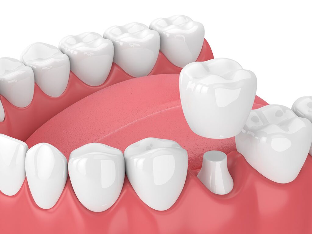 A DENTAL CROWN in FRANKLIN MI is a relatively quick and painless procedure
