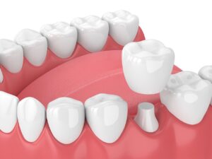 A DENTAL CROWN in FRANKLIN MI is a relatively quick and painless procedure