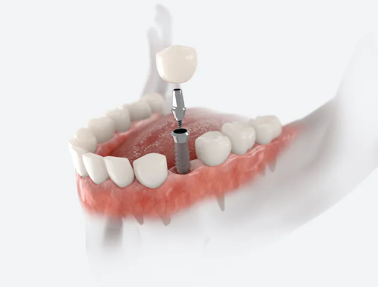 Why Dental Implants Are an Investment in Your Health in Franklin MI