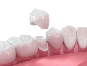 Crown vs. Filling: What Your Tooth Needs in Bingham Farms, MI